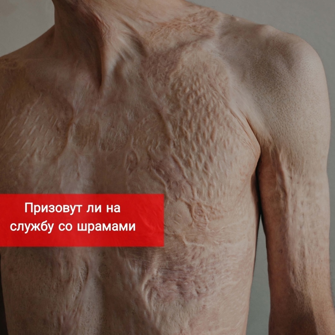 Призовут ли на службу со шрамами