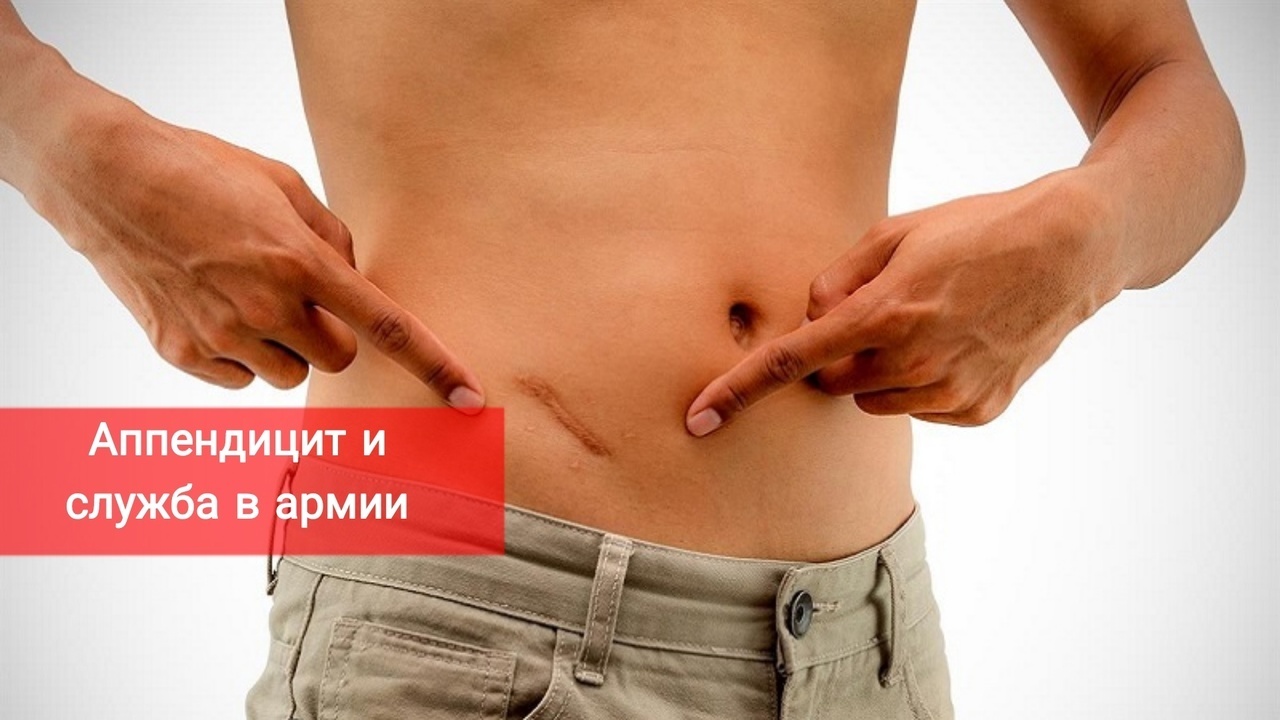 Аппендицит и служба в армии