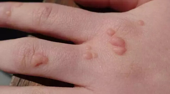 Он может вызывать рак! Можно ли избавиться от ВПЧ?