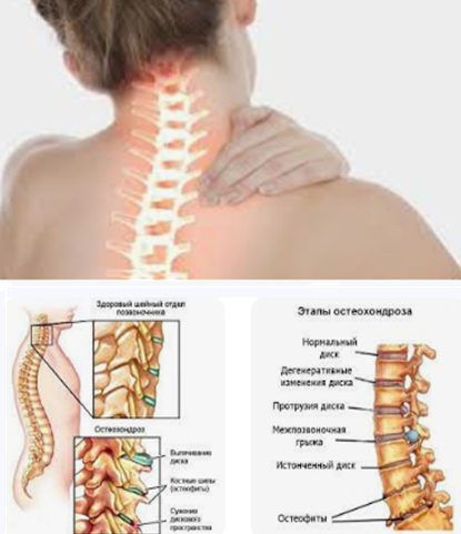 Целебная мазь из простых продуктов избавит вас от болей при шейном остеохондрозе