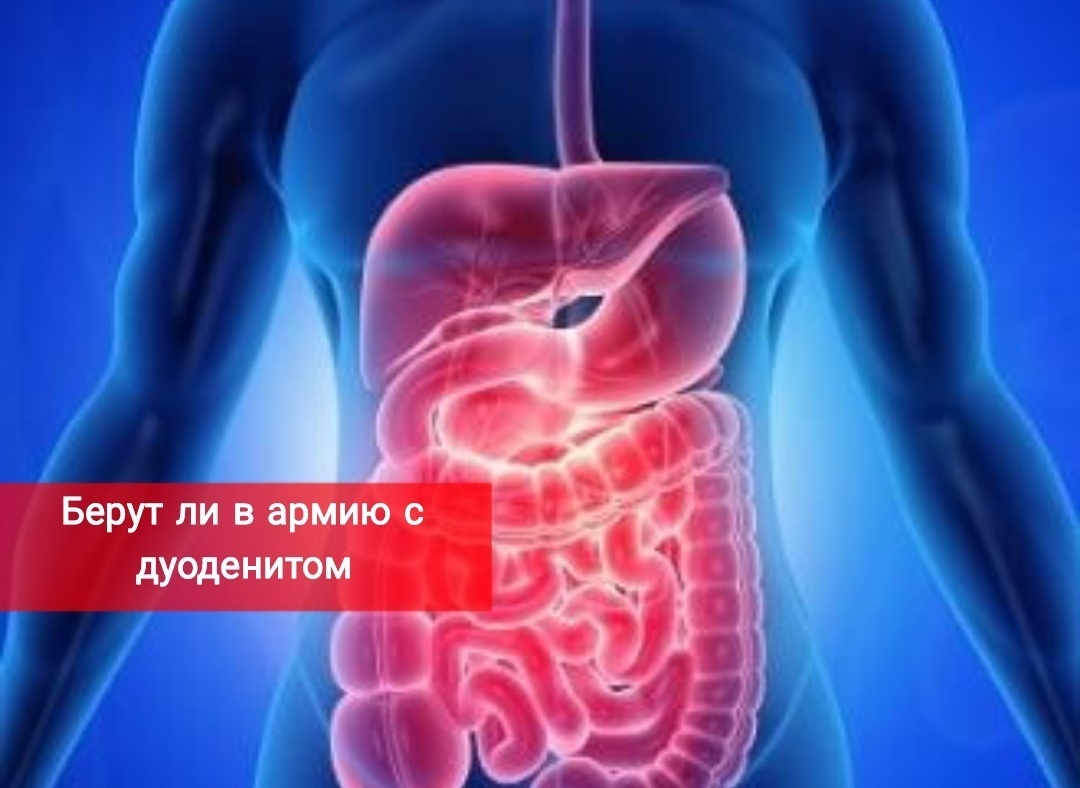 Берут ли в армию с дуоденитом
