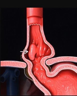 Полип пищевода: перспективы призыва в армию