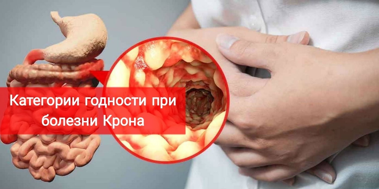 Категории годности при болезни Крона