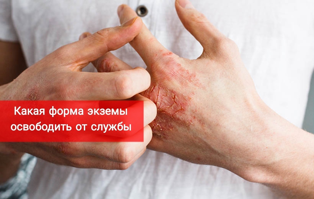 Какая форма экземы освободит от армии