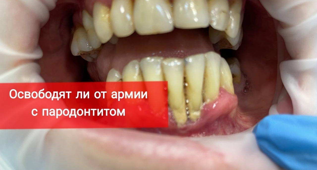 Освободит ли от армии пародонтит