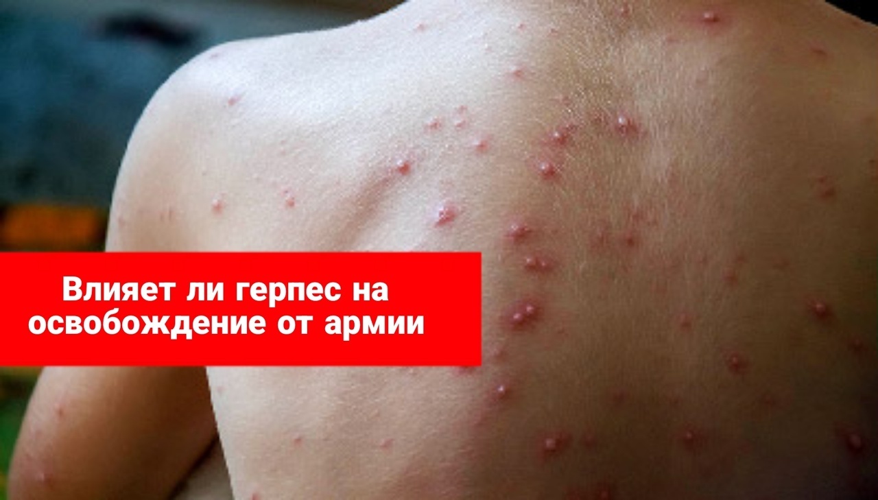 Влияет ли герпес на освобождение от армии