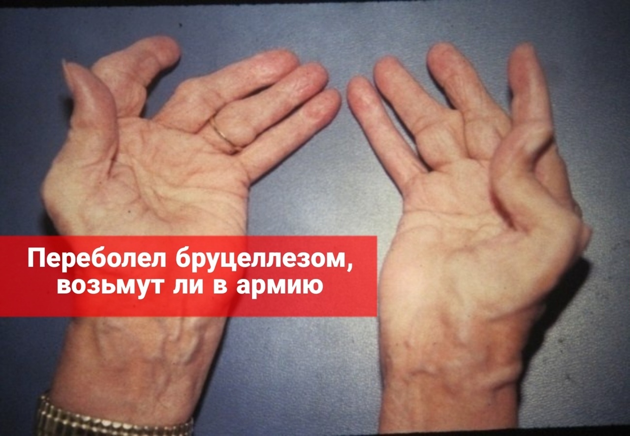 Переболел бруцеллезом, возьмут ли в армию