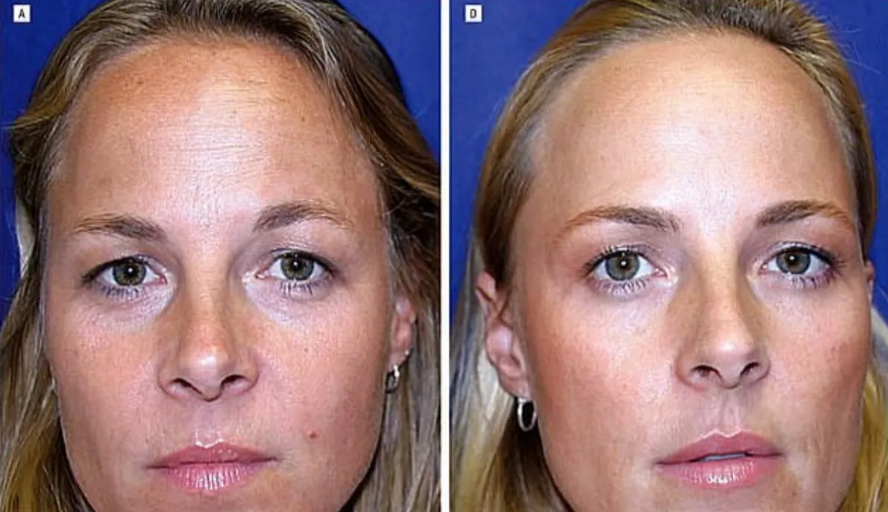 ✅ Кто выглядит лучше? - Одна близняшка ставила ботокс 20 лет, а вторая - нет (фото, опрос) 🧐