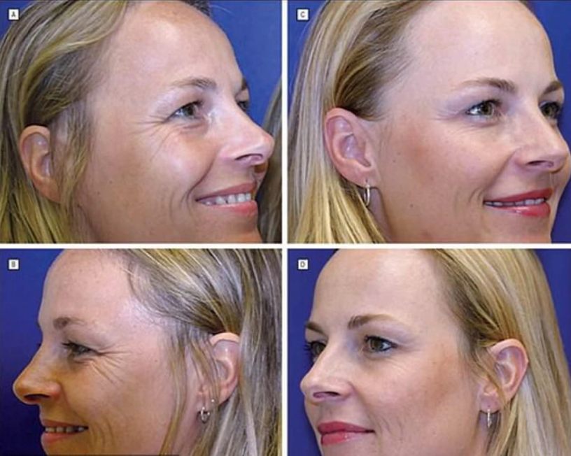 ✅ Кто выглядит лучше? - Одна близняшка ставила ботокс 20 лет, а вторая - нет (фото, опрос) 🧐