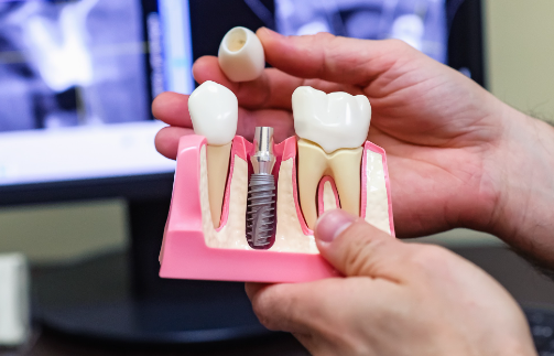 Зубной имплантат: сколько времени занимает заживление?