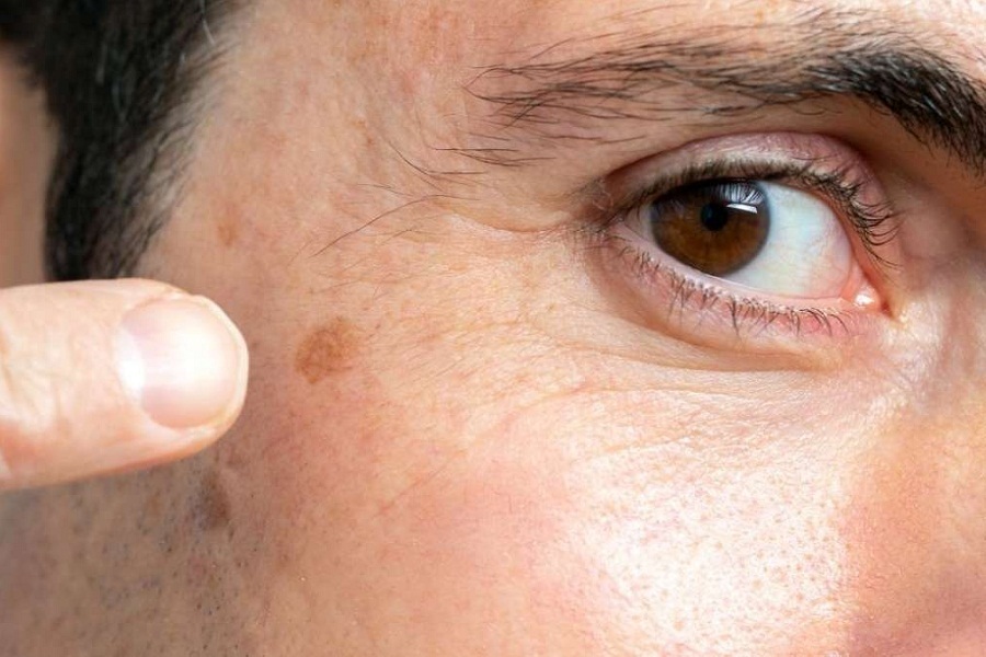 Как избавиться от пигментных пятен?
