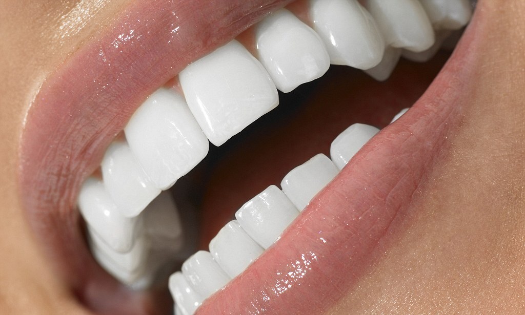 Виниры: Искусство Улучшения Улыбки или Ловушка Красоты?