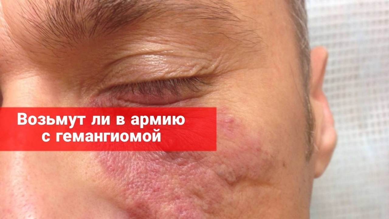 Возьмут ли в армию с гемангиомой