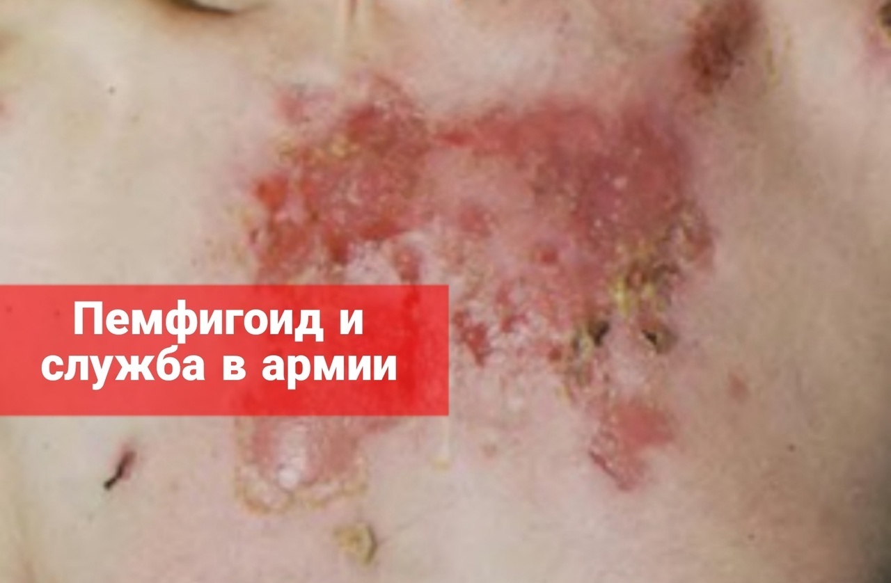 Пемфигоид и служба в армии
