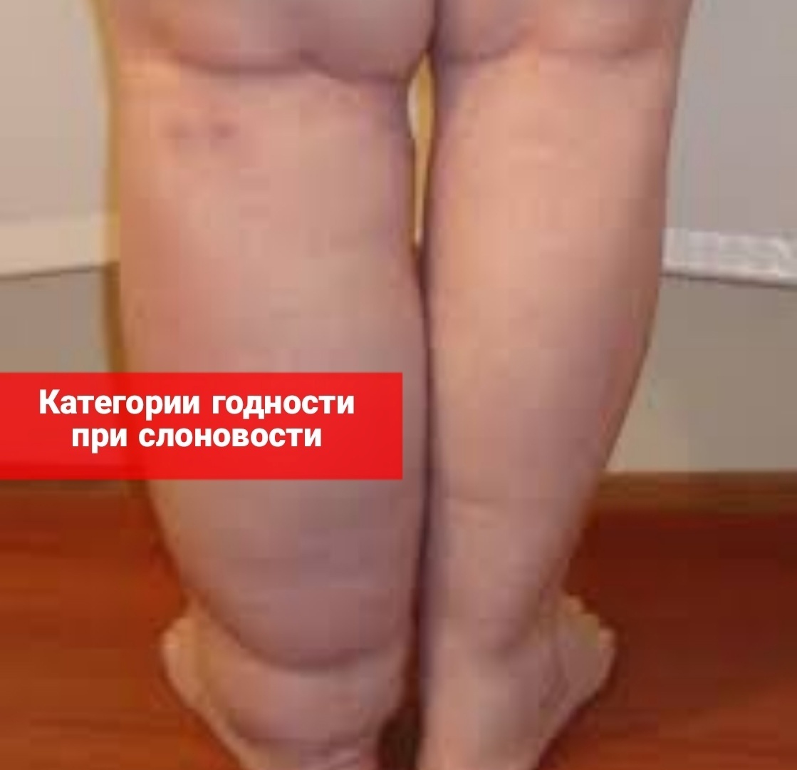 Категории годности при слоновости и ее виды