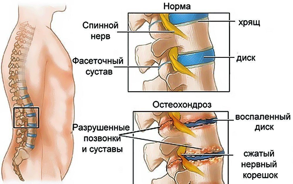 Остеохондроз диагностика лечение. Блокада фасеточного сустава l5-s1. Остеохондроз поясничного отдела позвоночника. Пояснично-крестцовый отдел позвоночника l3. Остеохондроз пояснично-крестцового отдела позвоночника.