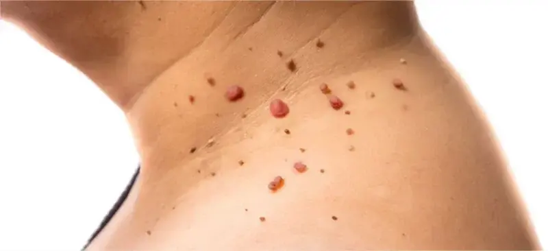 Что делать, если вас замучили папиломы?