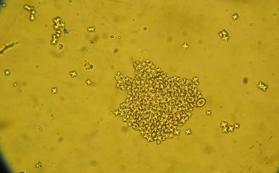 Лучше бы их не было: показываю и рассказываю про красивые кристаллы в моче