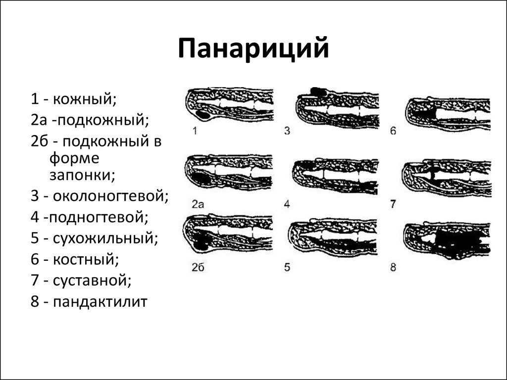 Панариций, опухоль ногтя пальца, причины и симптомы лечение | Булгарина  Ирина Александровна, 19 марта 2024