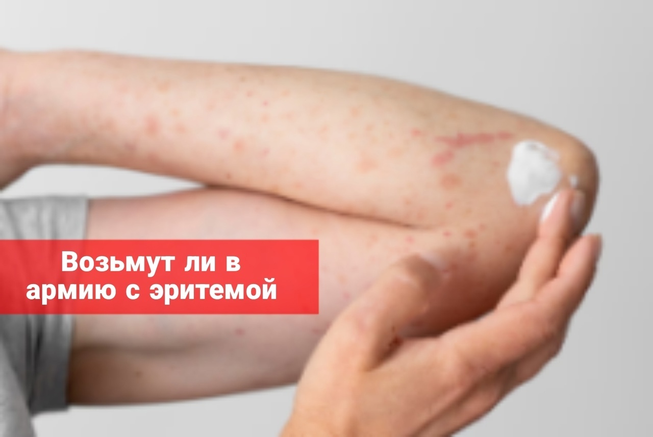 Возьмут ли в армию с эритемой