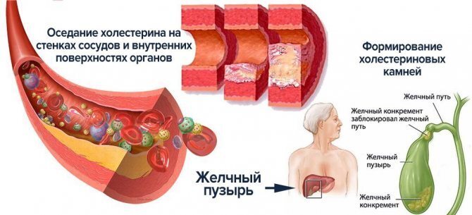 Холестероз стенок желчного