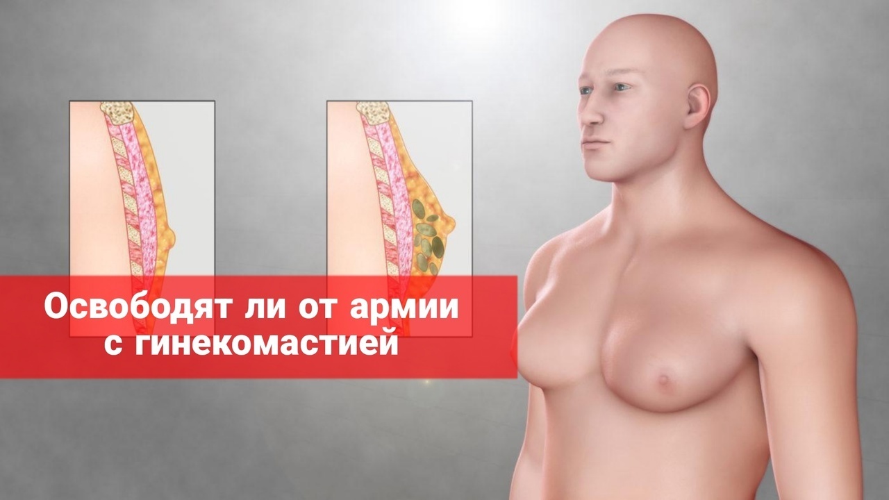 Освободят ли от армии с гинекомастией