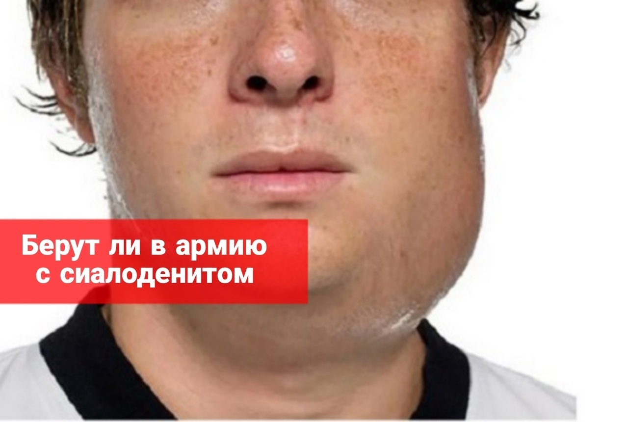 Берут ли в армию с сиалоденитом