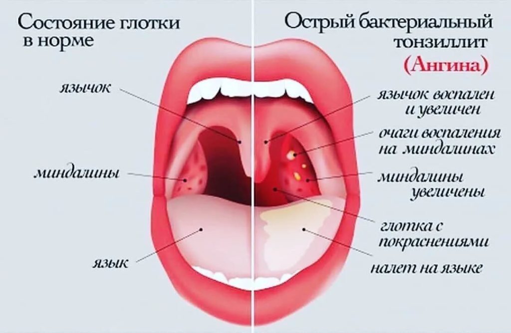 Можно Ли Купить При Ангине Взрослым