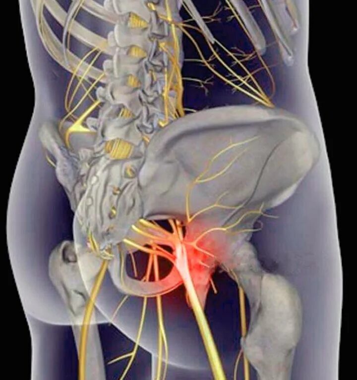 Люмбоишиалгия седалищного нерва. Остеохондроз люмбоишиалгия. Ишиас - защемление седалищного нерва.
