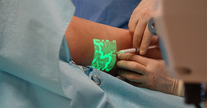 Лазерная хирургия при варикозном расширении вен.