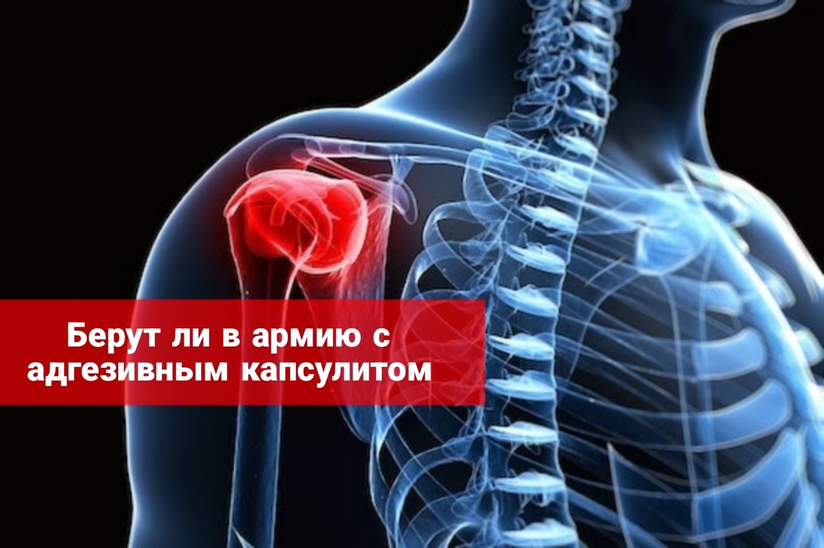 Берут ли в армию с адгезивным капсулитом