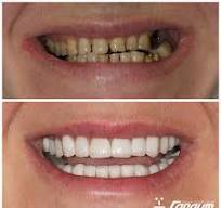 Как снять съемные виниры, купленные на Валдберриз? О чем умалчивают производители?