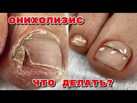 Онихолизис на ногах что делать .