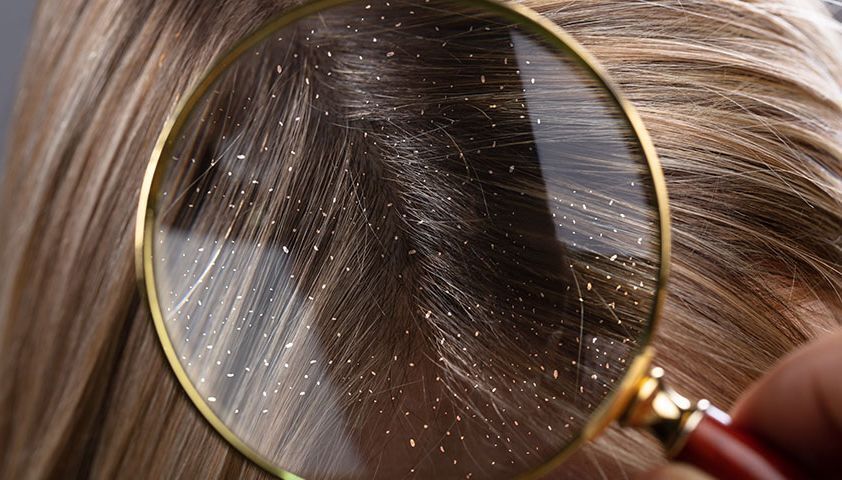 Почему появляется перхоть и как ее удалить: причины и способы борьбы