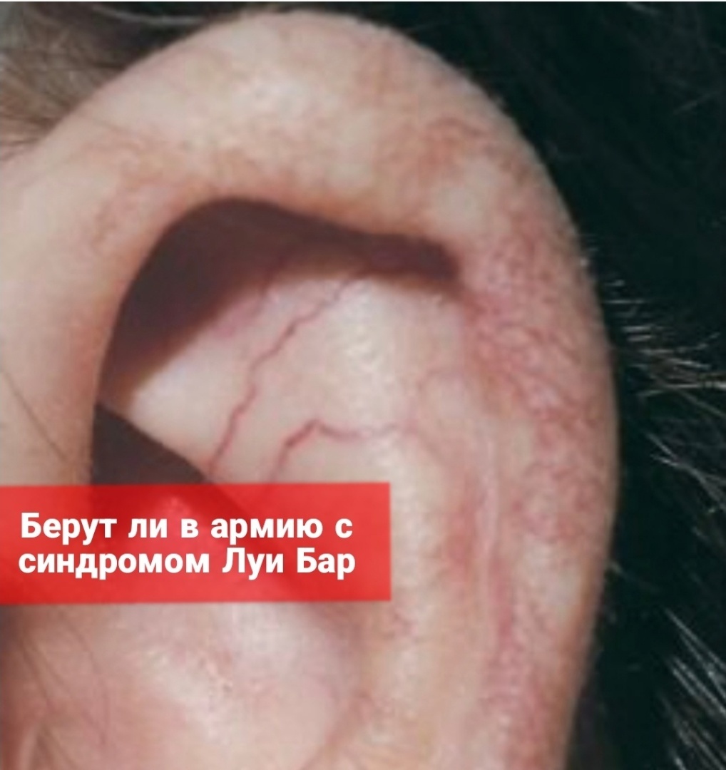 Берут ли в армию с синдромом Луи-Бар