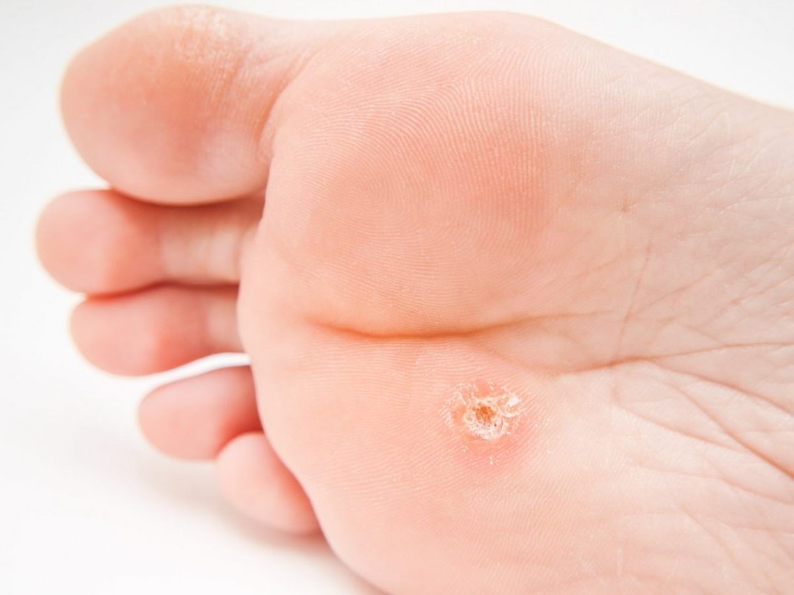 Подошвенные бородавки: причины появления, лечение