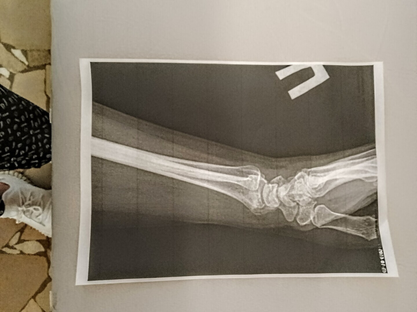 Как не сойти с ума, если ты сломала правую руку и осталась одна с собакой, двумя котами, дачей и жарой под 50…