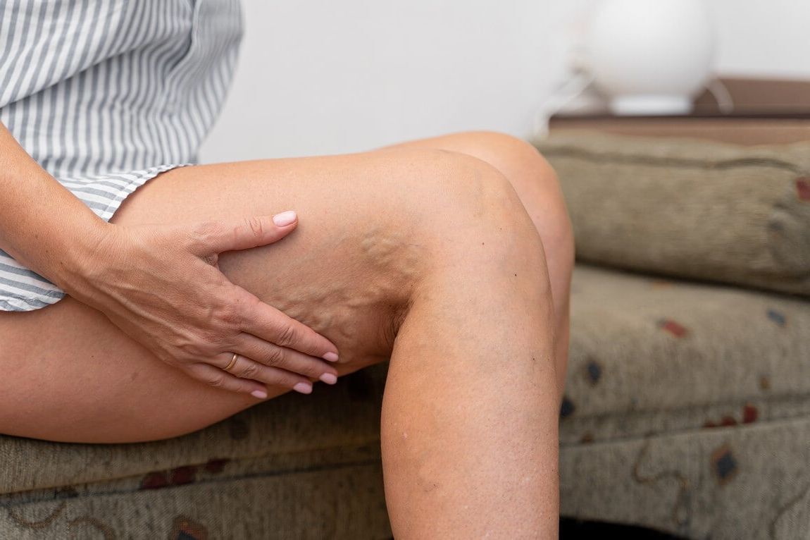 Как лечить варикоз в домашних условиях?