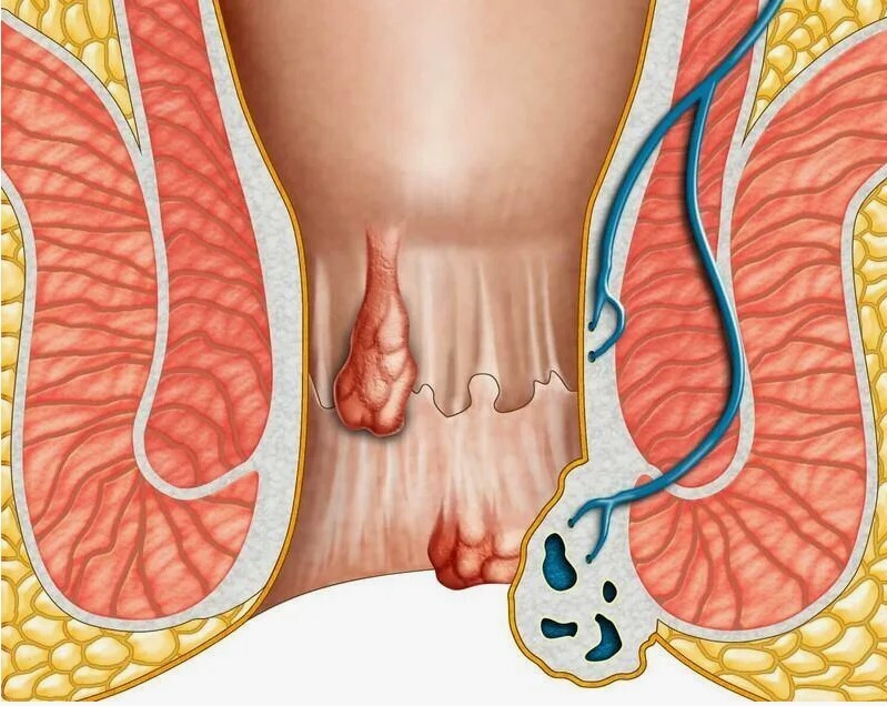 "Забытая болезнь: как избавиться от геморроя однажды и навсегда"