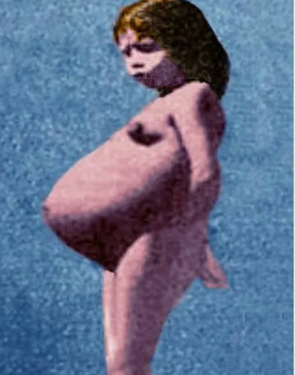 Лина Медина была самой молодой матерью в мире. Родила в 5 лет.