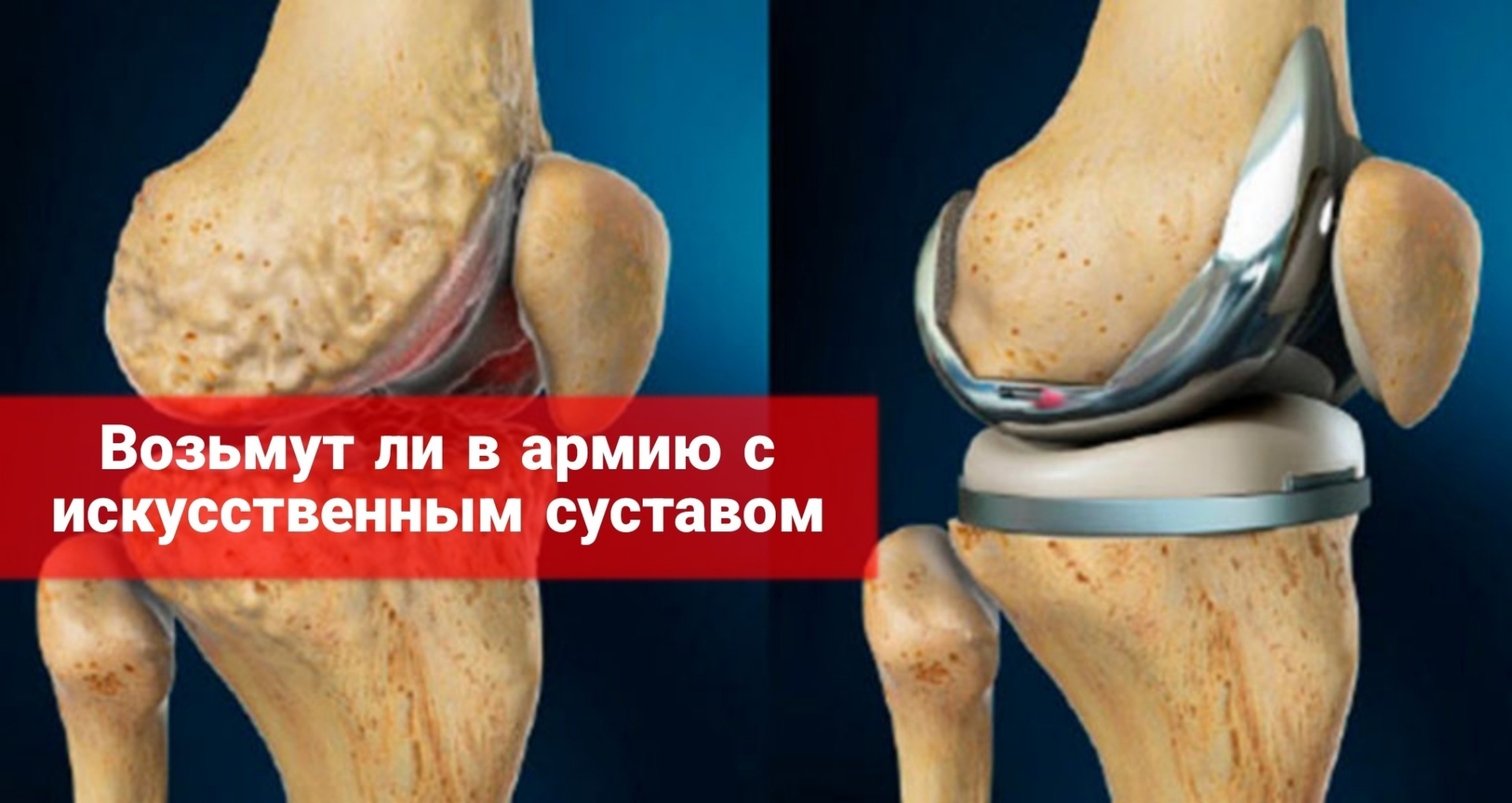 Возьмут ли в армию с искусственным суставом