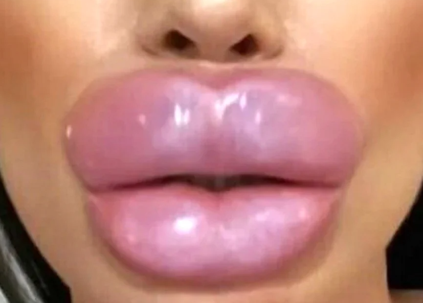 В Госдуме призвали регламентировать увеличение губ для женщин. Новая инициатива Виталия Милонова