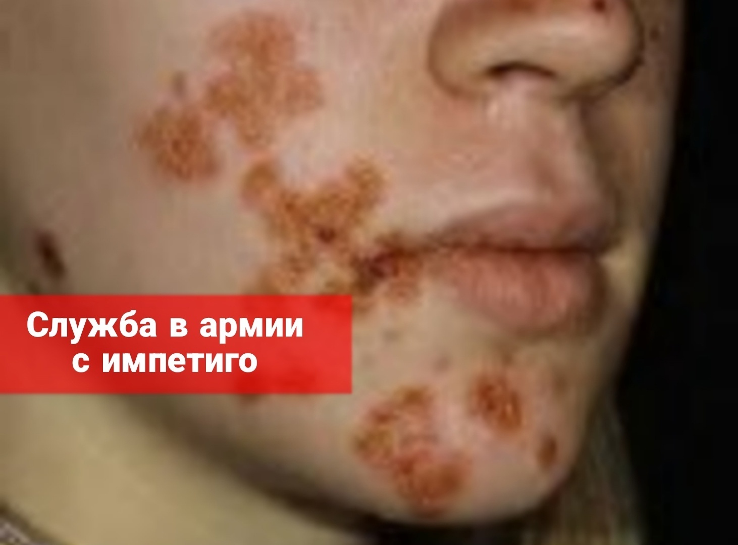 Служба в армии с импетиго
