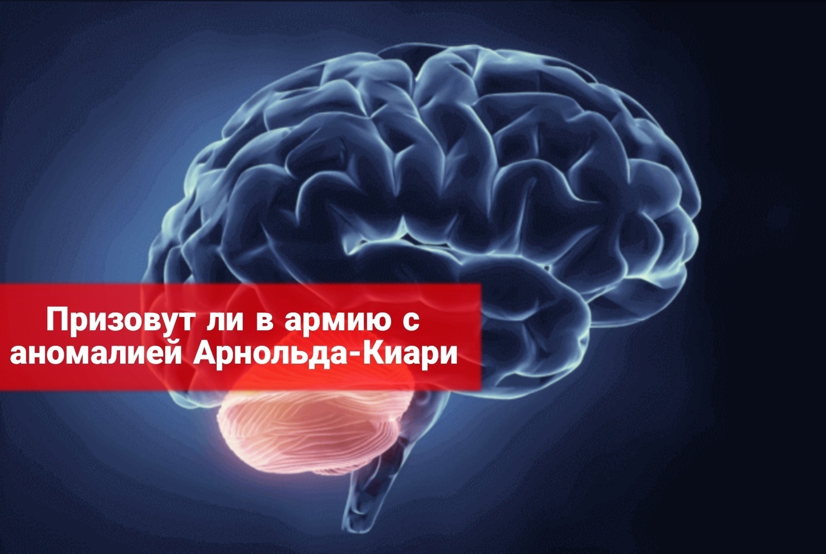 Призовут ли в армию с аномалией Арнольда Киари