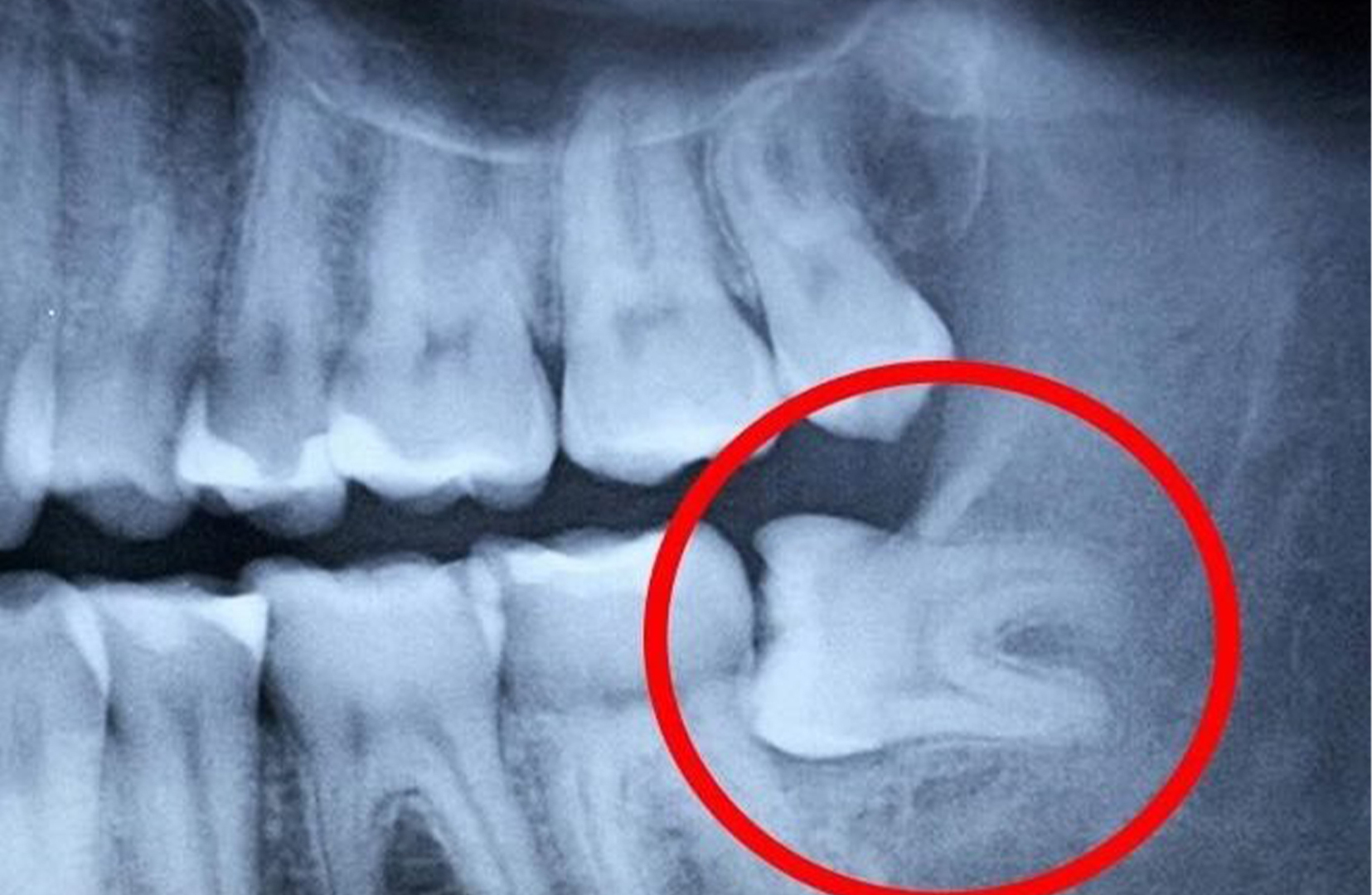 Насколько важно удалять зубы мудрости и что произойдет, если вы этого не сделаете?