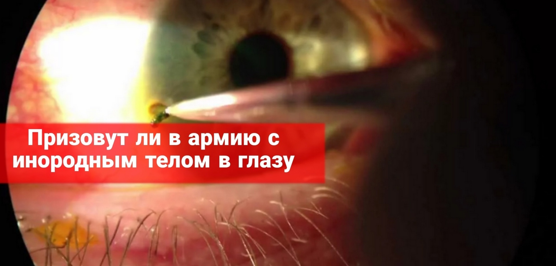 Призовут ли в армию с инородным телом в глазу