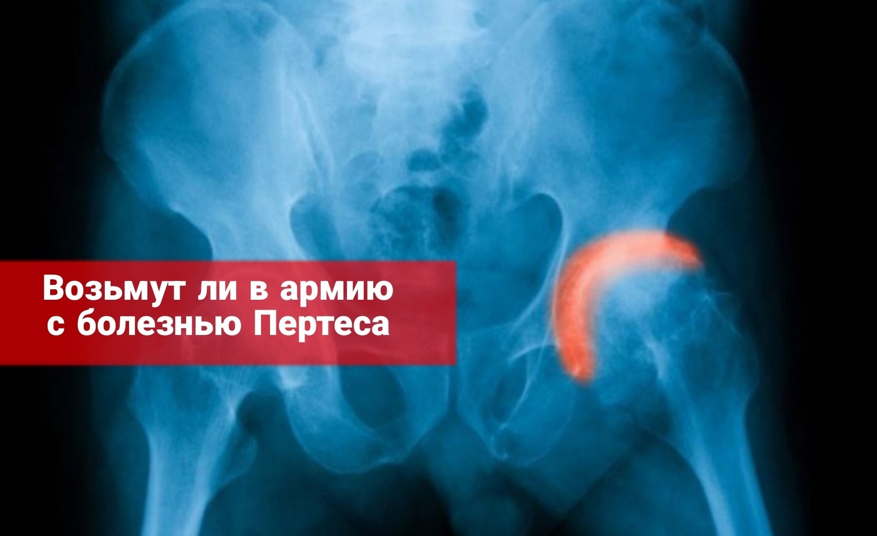 Возьмут ли в армию с болезнью Пертеса