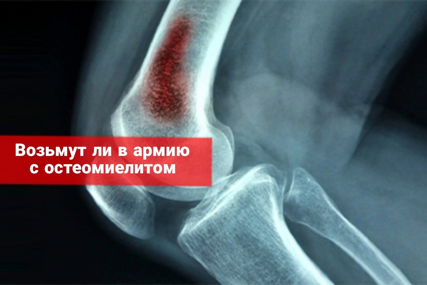 Возьмут ли в армию с остеомиелитом