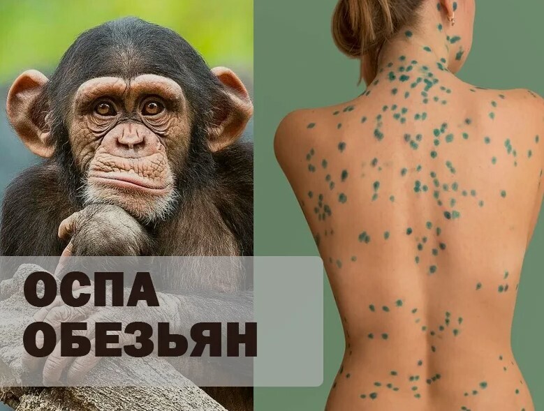 ⚡️ Глава Роспотребнадзора РФ Анна Попова заявила, что от оспы обезьян россиян защищают традиционные ценности 🙉😷