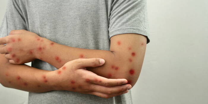 Оспа обезьян: все, что вам нужно знать о Mpox